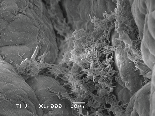 تصویر میکروسکوپ الکترونی از حضور پاتوژن ها در سلول های پوششی روده ای